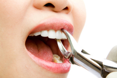 Estrazione dentale
