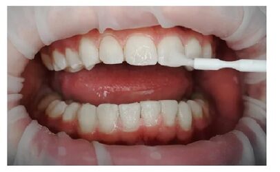 Fluorizzazione professionale