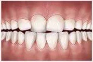 Tipi di malocclusione dentale