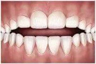 Tipi di malocclusione dentale