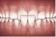 Tipi di malocclusione dentale