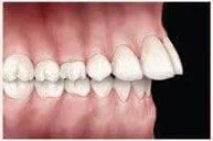 Tipi di malocclusione dentale