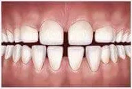 Tipi di malocclusione dentale