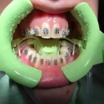 Apribocca ortodontico