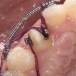 Bottone linguale trapezio per ortodonzia