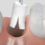 Emostasi e tamponamento dell'alveolo