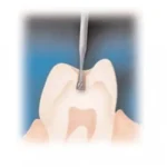 Fresa tungsteno contrangolo cono rovesciato - immagine 3