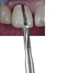 Fresa cross cut per taglio corona