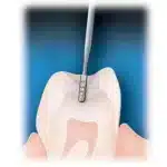 Fresa tungsteno preparazione cavità