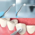 Ghiaccio spray 200ml - immagine 2