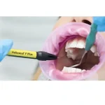 Helioseal F plus sigillatura