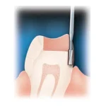 Fresa tungsteno cilindrica piatta contrangolo - immagine 2
