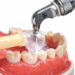 Micro sabbiatrice intraorale