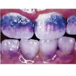 Mira 2 tone rivela placca e tartaro