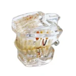 Modello con patologie dentali