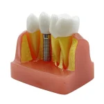 Modello didattico impianto dentale YL-M3