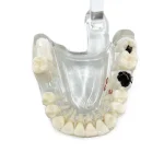 Modello dimostrativo patologie 31 denti - immagine 3
