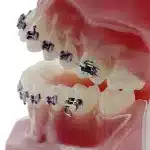 Modello dimostrativo apparecchio ortodontico metallo 009