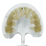 Modello dimostrativo con carie