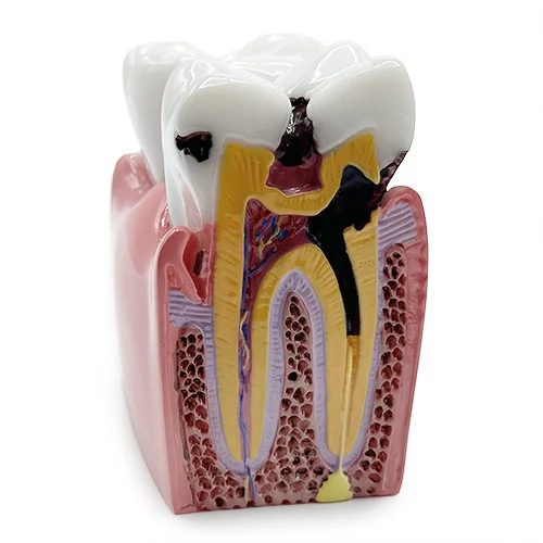 Modello dimostrativo con e senza carie YL-M2