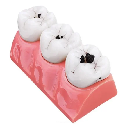 Modello dimostrativo evoluzione carie