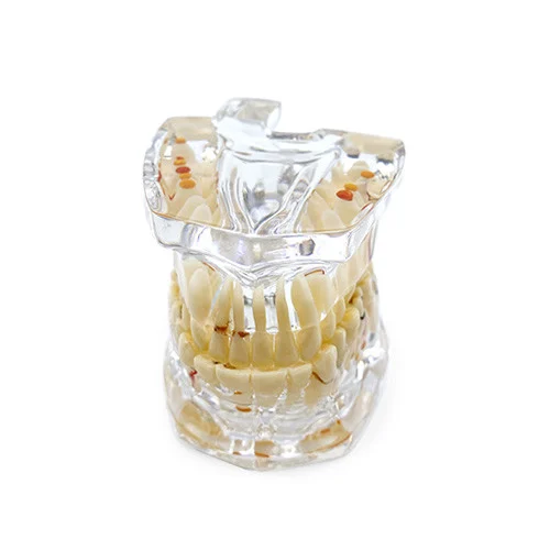 Modello dimostrativo patologia dentali 32 denti