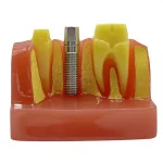 Modello impianto dentale YL-M3