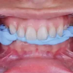 Occlufast CAD