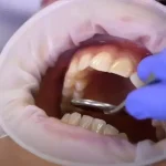 OptraGate 80pz - immagine 4