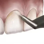 Polve air-flow profilassi