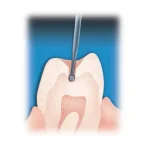 Fresa tungsteno sfera turbina - immagine 3