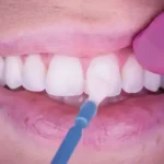 Profisil fluoride varnish 50x0.5ml applicazione