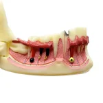 Sezione mandibola con patologie