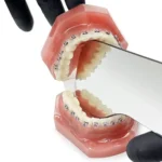 Specchio fotografia intraorale linguale