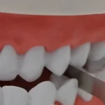 Misuratore spazio interdentale - immagine 4